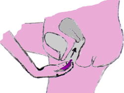 image de l'insertion de la coupe menstruelle